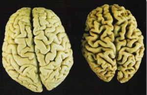 สมองโรคอัลไซเมอร์