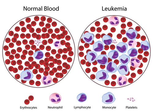 leukemia2